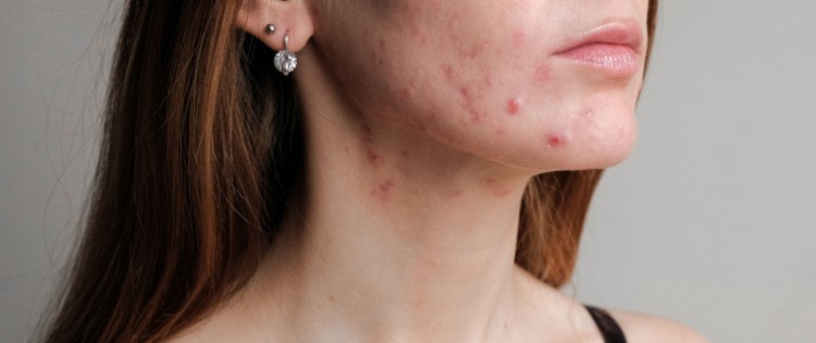 Ce sunt semnele post-acne și cum să le vindecăm!