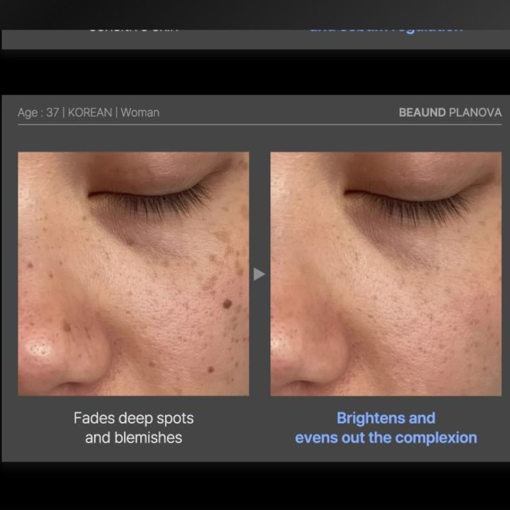 Dispozitiv facial cu tehnologie Cold Plasma pentru îngrijirea pielii