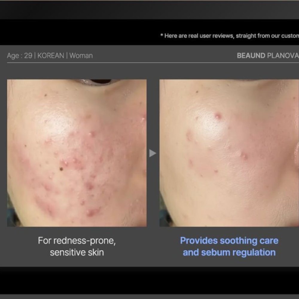 Dispozitiv facial cu tehnologie Cold Plasma pentru îngrijirea pielii