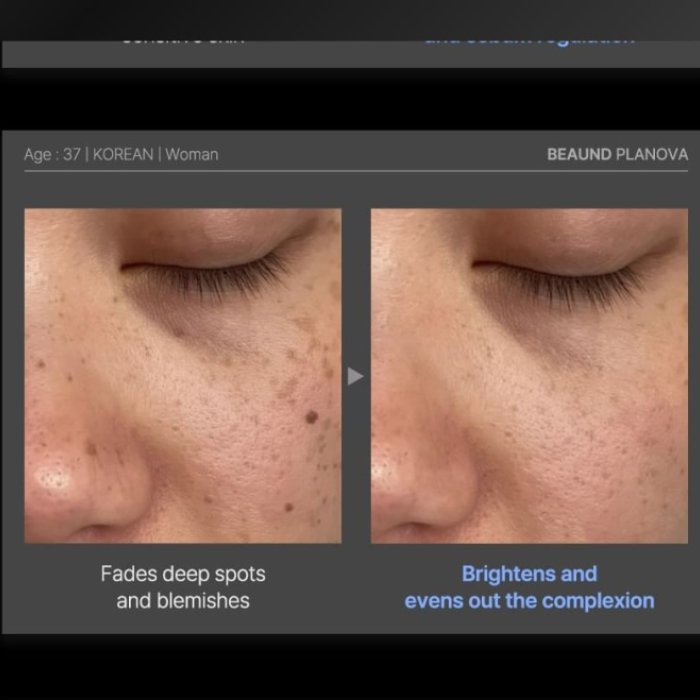 Dispozitiv facial cu tehnologie Cold Plasma pentru îngrijirea pielii