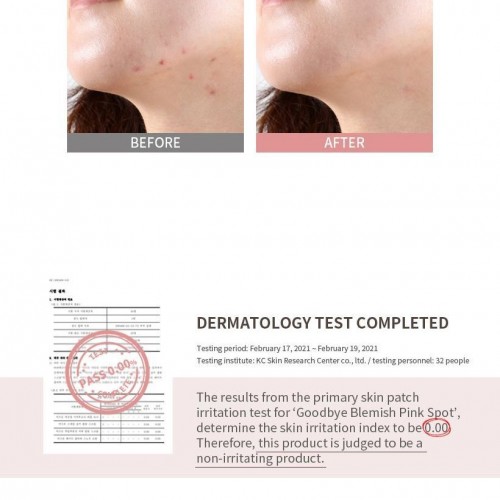 Remediu local pentru acnee pe fata